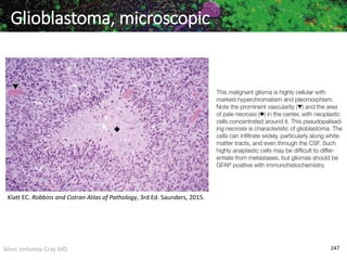 Marc Imhotep Cray MD 247
Glioblastoma, microscopic
Klatt EC. Robbins and Cotran Atlas of Pathology, 3rd Ed. Saunders, 2015.
 