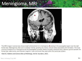 Marc Imhotep Cray MD 251
Meningioma, MRI
Klatt EC. Robbins and Cotran Atlas of Pathology, 3rd Ed. Saunders, 2015.
 