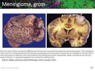 Marc Imhotep Cray MD 252
Meningioma, gross
Klatt EC. Robbins and Cotran Atlas of Pathology, 3rd Ed. Saunders, 2015.
 