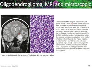 Marc Imhotep Cray MD 256
Oligodendroglioma, MRI and microscopic
Klatt EC. Robbins and Cotran Atlas of Pathology, 3rd Ed. Saunders, 2015.
 