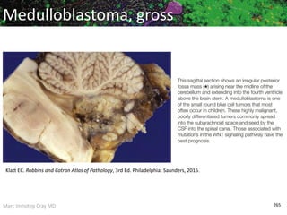 Marc Imhotep Cray MD 265
Medulloblastoma, gross
Klatt EC. Robbins and Cotran Atlas of Pathology, 3rd Ed. Philadelphia: Saunders, 2015.
 