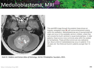 Marc Imhotep Cray MD 266
Medulloblastoma, MRI
Klatt EC. Robbins and Cotran Atlas of Pathology, 3rd Ed. Philadelphia: Saunders, 2015.
 