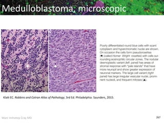 Marc Imhotep Cray MD 267
Medulloblastoma, microscopic
Klatt EC. Robbins and Cotran Atlas of Pathology, 3rd Ed. Philadelphia: Saunders, 2015.
 