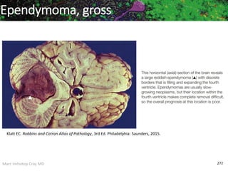 Marc Imhotep Cray MD 272
Ependymoma, gross
Klatt EC. Robbins and Cotran Atlas of Pathology, 3rd Ed. Philadelphia: Saunders, 2015.
 