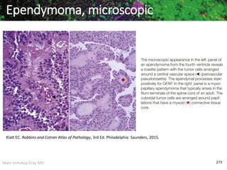 Marc Imhotep Cray MD 273
Ependymoma, microscopic
Klatt EC. Robbins and Cotran Atlas of Pathology, 3rd Ed. Philadelphia: Saunders, 2015.
 