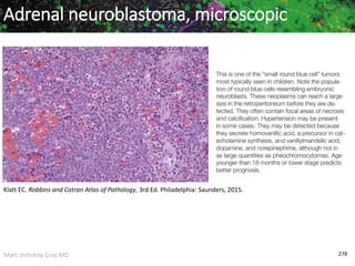Marc Imhotep Cray MD 278
Adrenal neuroblastoma, microscopic
Klatt EC. Robbins and Cotran Atlas of Pathology, 3rd Ed. Philadelphia: Saunders, 2015.
 