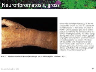 Marc Imhotep Cray MD 282
Neurofibromatosis, gross
Klatt EC. Robbins and Cotran Atlas of Pathology, 3rd Ed. Philadelphia: Saunders, 2015.
 