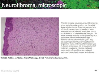Marc Imhotep Cray MD 283
Neurofibroma, microscopic
Klatt EC. Robbins and Cotran Atlas of Pathology, 3rd Ed. Philadelphia: Saunders, 2015.
 