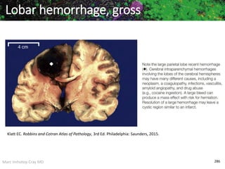 Marc Imhotep Cray MD 286
Lobar hemorrhage, gross
Klatt EC. Robbins and Cotran Atlas of Pathology, 3rd Ed. Philadelphia: Saunders, 2015.
 