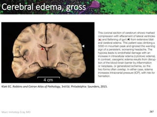 Marc Imhotep Cray MD
Klatt EC. Robbins and Cotran Atlas of Pathology, 3rd Ed. Philadelphia: Saunders, 2015.
287
Cerebral edema, gross
 