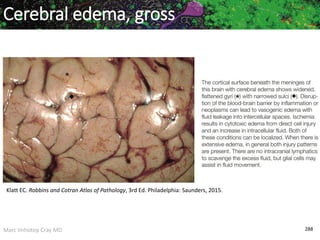 Marc Imhotep Cray MD 288
Klatt EC. Robbins and Cotran Atlas of Pathology, 3rd Ed. Philadelphia: Saunders, 2015.
Cerebral edema, gross
 
