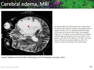 Marc Imhotep Cray MD 289
Klatt EC. Robbins and Cotran Atlas of Pathology, 3rd Ed. Philadelphia: Saunders, 2015.
Cerebral edema, MRI
 
