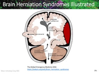 Marc Imhotep Cray MD 291
Brain Herniation Syndromes Illustrated
The Global Emergency Medicine Wiki
https://wikem.org/wiki/Brain_herniation_syndromes
 