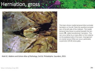 Marc Imhotep Cray MD 295
Herniation, gross
Klatt EC. Robbins and Cotran Atlas of Pathology, 3rd Ed. Philadelphia: Saunders, 2015.
 