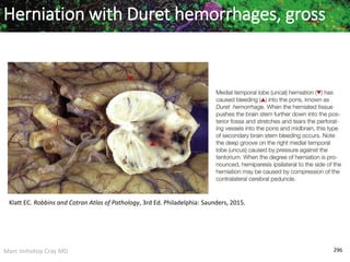 Marc Imhotep Cray MD 296
Herniation with Duret hemorrhages, gross
Klatt EC. Robbins and Cotran Atlas of Pathology, 3rd Ed. Philadelphia: Saunders, 2015.
 