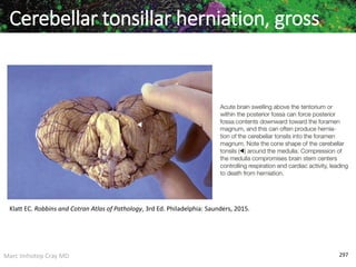 Marc Imhotep Cray MD 297
Cerebellar tonsillar herniation, gross
Klatt EC. Robbins and Cotran Atlas of Pathology, 3rd Ed. Philadelphia: Saunders, 2015.
 