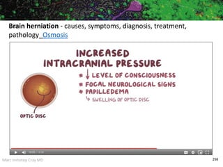 Marc Imhotep Cray MD 298
Brain herniation - causes, symptoms, diagnosis, treatment,
pathology_Osmosis
 