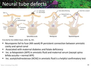 Marc Imhotep Cray MD 43
First Aid for the USMLE Step1, 2020, Pg. 491.
Neural tube defects
 Neuropores fail to fuse (4th week) persistent connection between amniotic
cavity and spinal canal
 Associated with maternal diabetes and folate deficiency
 Inc. α-fetoprotein (AFP) in amniotic fluid and maternal serum (except spina
bifida occulta = normal AFP)
 Inc. acetylcholinesterase (AChE) in amniotic fluid is a helpful confirmatory test
 