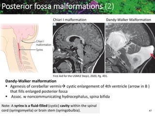 Marc Imhotep Cray MD 47
Chiari I malformation Dandy-Walker Malformation
Dandy-Walker malformation
 Agenesis of cerebellar vermis cystic enlargement of 4th ventricle (arrow in B )
that fills enlarged posterior fossa
 Assoc. w noncommunicating hydrocephalus, spina bifida
First Aid for the USMLE Step1, 2020, Pg. 491.
Note: A syrinx is a fluid-filled (cystic) cavity within the spinal
cord (syringomyelia) or brain stem (syringobulbia).
Posterior fossa malformations (2)
 