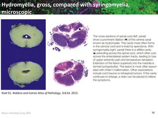 Marc Imhotep Cray MD 50
Hydromyelia, gross, compared with syringomyelia,
microscopic
Klatt EC. Robbins and Cotran Atlas of Pathology, 3rd Ed. 2015.
 