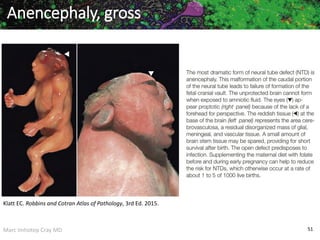 Marc Imhotep Cray MD 51
Klatt EC. Robbins and Cotran Atlas of Pathology, 3rd Ed. 2015.
Anencephaly, gross
 