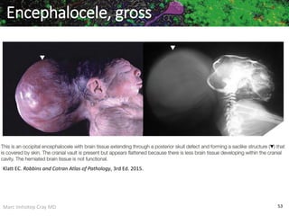 Marc Imhotep Cray MD 53
Encephalocele, gross
Klatt EC. Robbins and Cotran Atlas of Pathology, 3rd Ed. 2015.
 