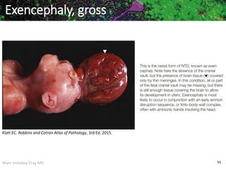 Marc Imhotep Cray MD 55
Exencephaly, gross
Klatt EC. Robbins and Cotran Atlas of Pathology, 3rd Ed. 2015.
 