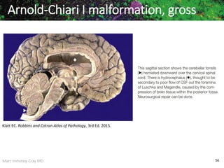 Marc Imhotep Cray MD 56
Arnold-Chiari I malformation, gross
Klatt EC. Robbins and Cotran Atlas of Pathology, 3rd Ed. 2015.
 