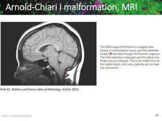 Marc Imhotep Cray MD 57
Arnold-Chiari I malformation, MRI
Klatt EC. Robbins and Cotran Atlas of Pathology, 3rd Ed. 2015.
 