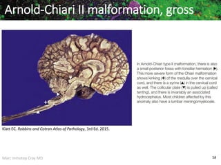 Marc Imhotep Cray MD 58
Arnold-Chiari II malformation, gross
Klatt EC. Robbins and Cotran Atlas of Pathology, 3rd Ed. 2015.
 