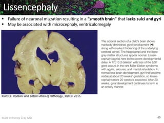 Marc Imhotep Cray MD 60
 Failure of neuronal migration resulting in a “smooth brain” that lacks sulci and gyri
 May be associated with microcephaly, ventriculomegaly
Lissencephaly
Klatt EC. Robbins and Cotran Atlas of Pathology, 3rd Ed. 2015.
 