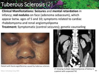 Marc Imhotep Cray MD
Tuberous Sclerosis (2)
Clinical Manifestations: Seizures and mental retardation in
infancy; red nodules on face (adenoma sebaceum), which
appear betw. ages of 5 and 10; symptoms related to cardiac
rhabdomyoma and renal angiomyolipoma
Treatment: Symptomatic (control seizures); genetic counseling
Patient with facial angiofibromas caused by tuberous sclerosis
CT showing multiple angiomyolipomas of kidney in
a patient with suspected TSC 65
 