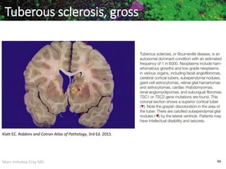 Marc Imhotep Cray MD 66
Klatt EC. Robbins and Cotran Atlas of Pathology, 3rd Ed. 2015.
Tuberous sclerosis, gross
 
