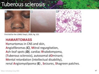 Marc Imhotep Cray MD 67
HAMARTOMASS
Hamartomas in CNS and skin,
Angiofibromas (C), Mitral regurgitation,
Ash-leaf spots (D), cardiac Rhabdomyoma,
(Tuberous sclerosis), autosomal dOminant;
Mental retardation (intellectual disability),
renal Angiomyolipoma (E) , Seizures, Shagreen patches.
Tuberous sclerosis
First Aid for the USMLE Step1, 2020, Pg. 525.
 