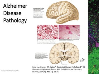 Marc Imhotep Cray MD 76
Alzheimer
Disease
Pathology
Buja, LM; Krueger GR. Netter’s Illustrated Human Pathology 2nd Ed.
Illustrations by Frank H. Netter, MD. Philadelphia, PA: Saunders-
Elsevier, 2014; Pg. 482, Fig. 13-38.
 
