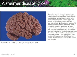 Marc Imhotep Cray MD 79
Alzheimer disease, gross
Klatt EC. Robbins and Cotran Atlas of Pathology, 3rd Ed. 2015.
 