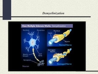 Demyelinization
 