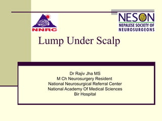 Lump Under Scalp
Dr Rajiv Jha MS
M Ch Neurosurgery Resident
National Neurosurgical Referral Center
National Academy Of Medical Sciences
Bir Hospital
 