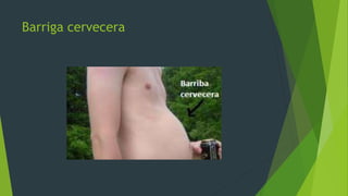 Barriga cervecera
 