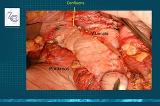 Pankreas V.Lienalis Confluens 