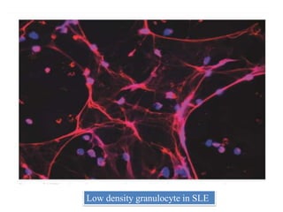 Low density granulocyte in SLE
 