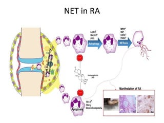 NET in RA
 