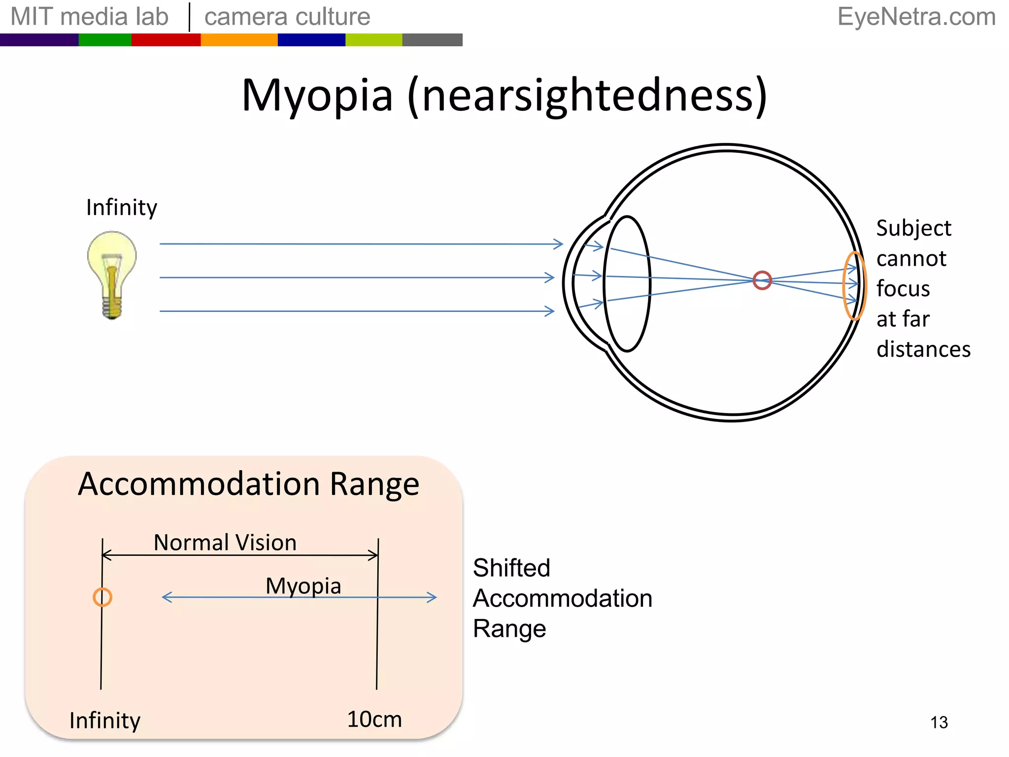 Myopia (nearsightedness)InfinitySubject cannot focusat far distancesAccommodation RangeNormal VisionShifted Accommodation RangeMyopia10cmInfinity13