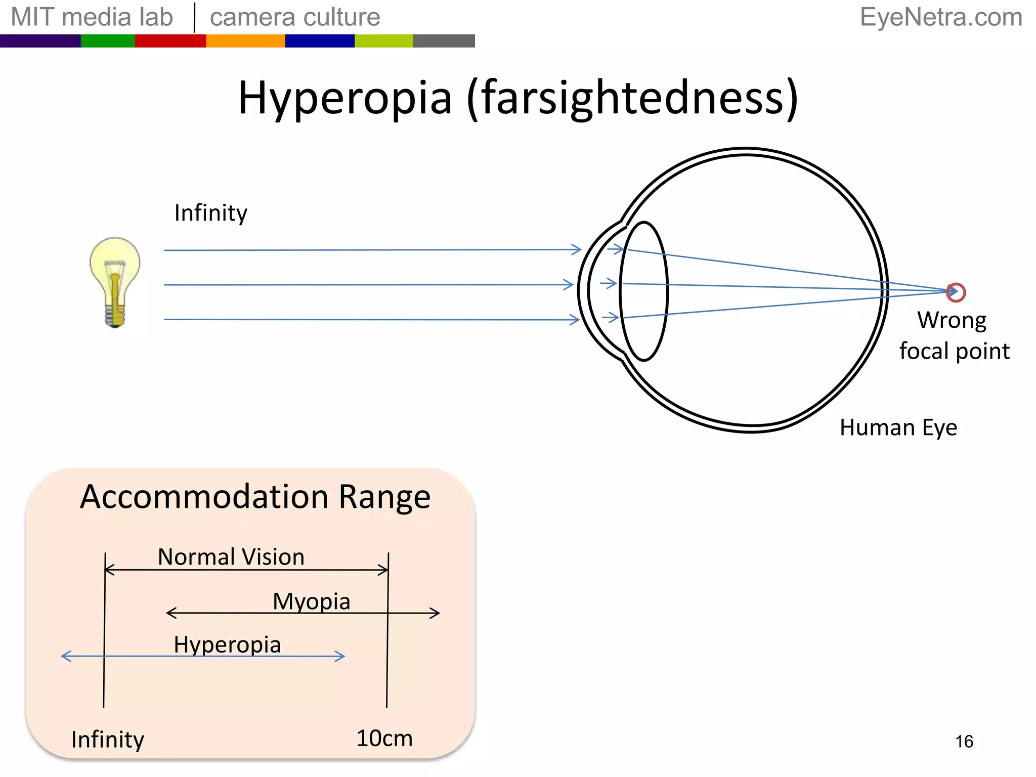 Myopia CorrectionInfinitySubject can focusat infinityDivergent LensHuman EyeAccommodation RangeNormal VisionCorrected MyopiaMyopia10cmInfinity15