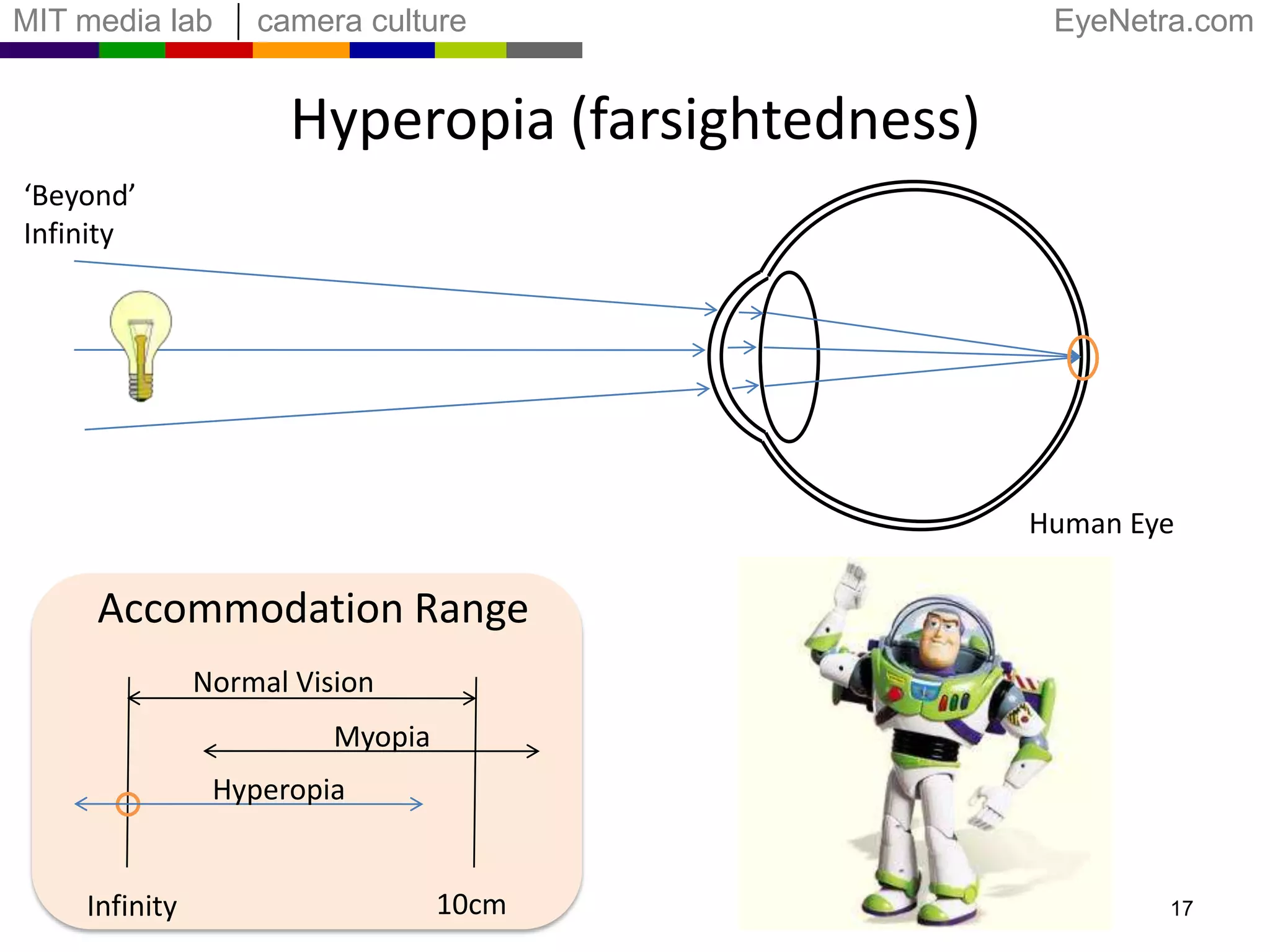 Hyperopia (farsightedness)InfinityWrong focal pointHuman EyeAccommodation RangeNormal VisionMyopiaHyperopia10cmInfinity16