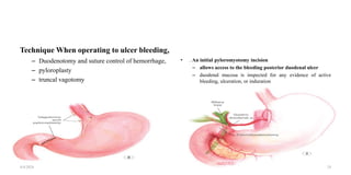 Technique When operating to ulcer bleeding,
– Duodenotomy and suture control of hemorrhage,
– pyloroplasty
– truncal vagotomy
• . An initial pyloromyotomy incision
– allows access to the bleeding posterior duodenal ulcer
– duodenal mucosa is inspected for any evidence of active
bleeding, ulceration, or induration
4/4/2024 24
 
