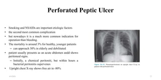 Perforated Peptic Ulcer
• Smoking and NSAIDs are important etiologic factors
• the second most common complication
• but nowadays it is a much more common indication for
operation than bleeding.
• The mortality is around 3% for healthy, younger patients
– can approach 30% in elderly and debilitated
• patient usually presents as an acute abdomen andd shows
peritoneal signs.
– Initially, a chemical peritoniti, but within hours a
bacterial peritonitis supervenes
• Upright chest X-ray shows free air in -80%
4/4/2024 27
 