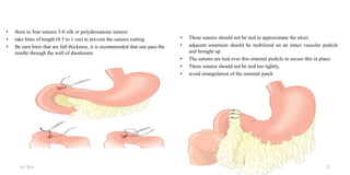 • three to four sutures 3-0 silk or polydioxanone sutures
• take bites of length (0.5 to 1 cm) to prevent the sutures cutting
• Be sure bites that are full thickness, it is recommended that one pass the
needle through the wall of duodenum
• These sutures should not be tied to approximate the ulcer;
• adjacent omentum should be mobilized on an intact vascular pedicle
and brought up.
• The sutures are tied over this omental pedicle to secure this in place.
• These sutures should not be tied too tightly,
• avoid strangulation of the omental patch
4/4/2024 32
 