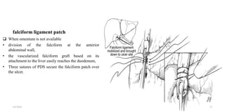 falciform ligament patch
 When omentum is not available
• division of the falciform at the anterior
abdominal wall,
• the vascularized falciform graft based on its
attachment to the liver easily reaches the duodenum,
• Three sutures of PDS secure the falciform patch over
the ulcer.
4/4/2024 33
 