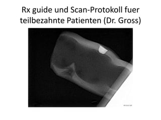 Rx guide und Scan-Protokoll fuer
teilbezahnte Patienten (Dr. Gross)
 